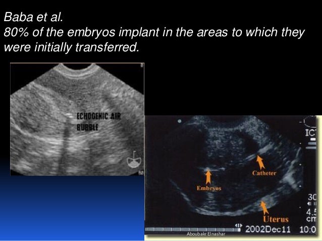embryo transfer not ultrasound guided
