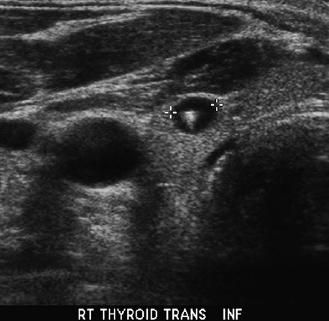 ultrasound guided needle biopsy parotid gland